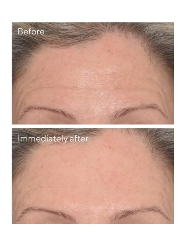 Targeted Wrinkle Correcto